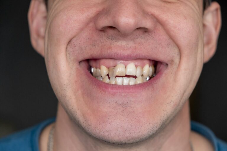 A man's crooked teeth. Young man showing crooked growing teeth.